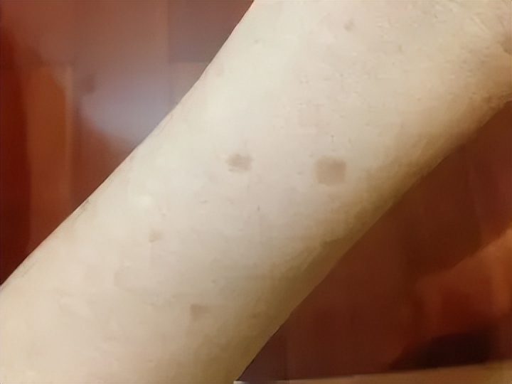 老年斑和色素沉着怎么治,老年人色素沉着怎么去除