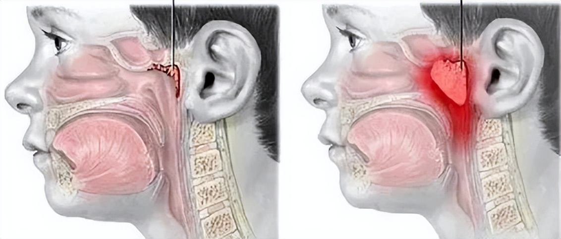 腺样体肥大造成嘴唇变厚会变丑吗,用嘴呼吸变丑还是腺样体肥大变丑