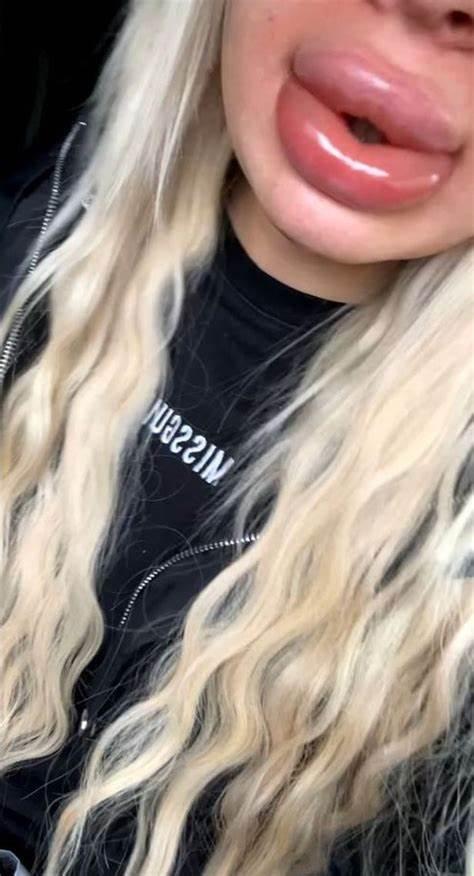 丰唇失败变成香肠嘴,丰唇手术后变成香肠嘴