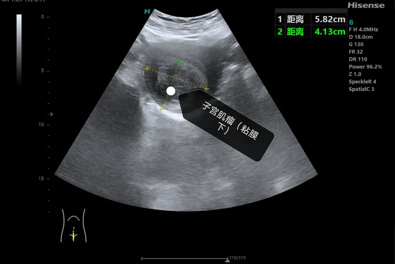 子宫肌瘤是怎么患上的,得了子宫肌瘤该如何是好