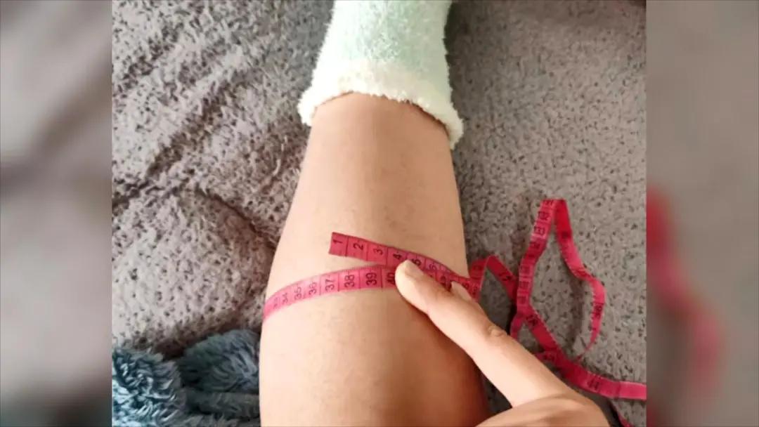 腿部抽脂一年了腿部拉扯疼,腿部抽脂为啥腿发木