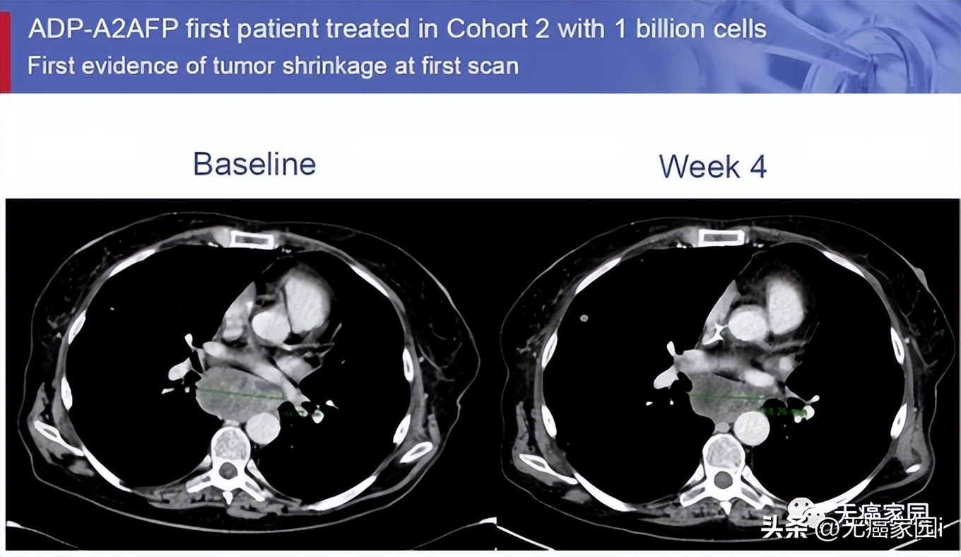 抗癌新技术真的出来了吗,最新靶向抗癌新药