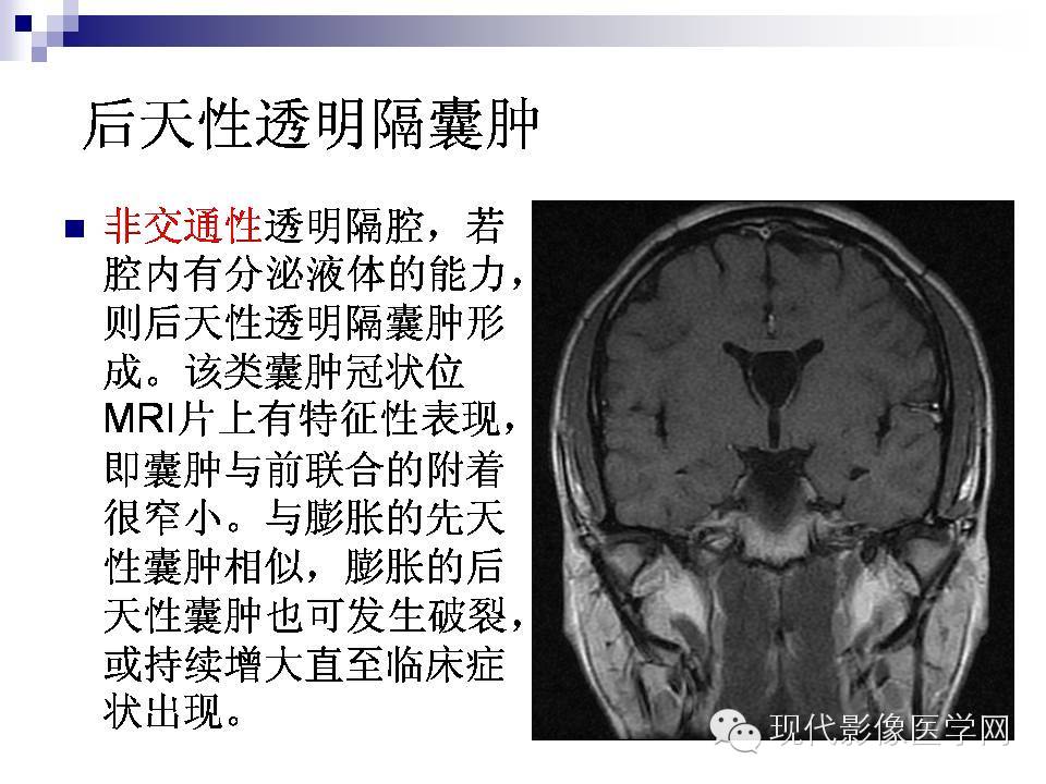 透明隔缺失影像学表现,透明隔腔影像