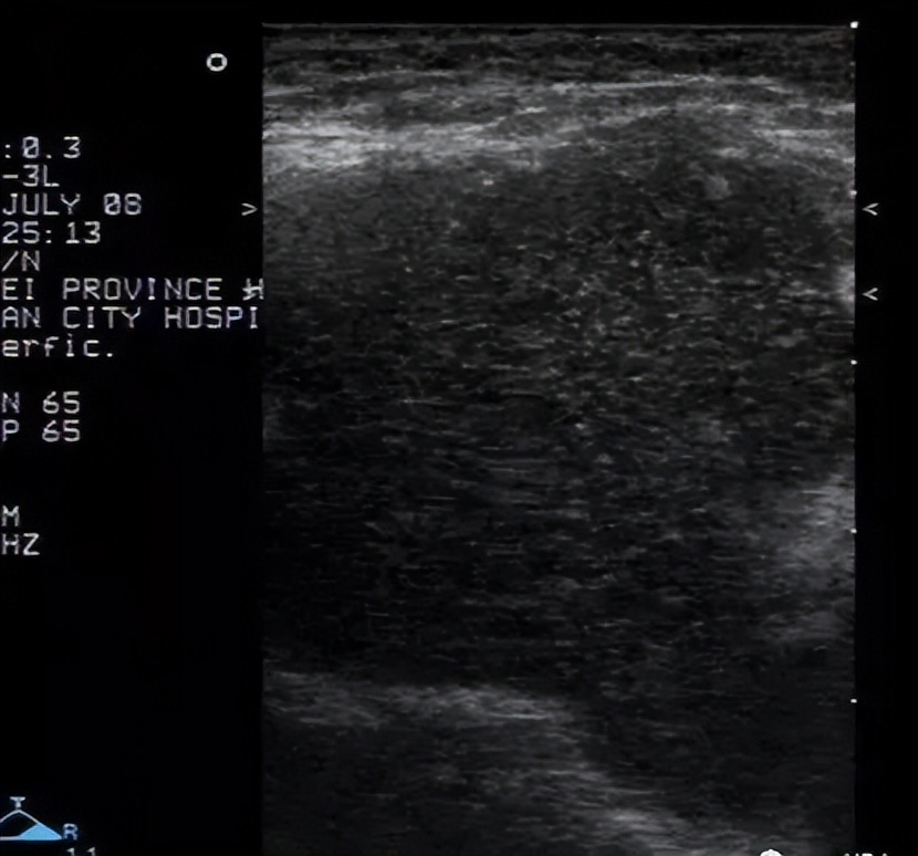 腋窝包块超声鉴别诊断,腋窝淋巴结检查法