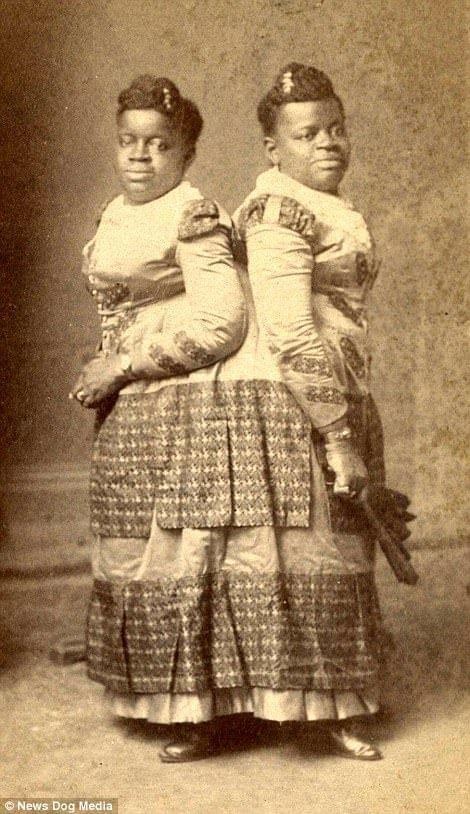 连体双胞胎姐妹的悲惨人生,双胞胎姐妹一个死亡后续