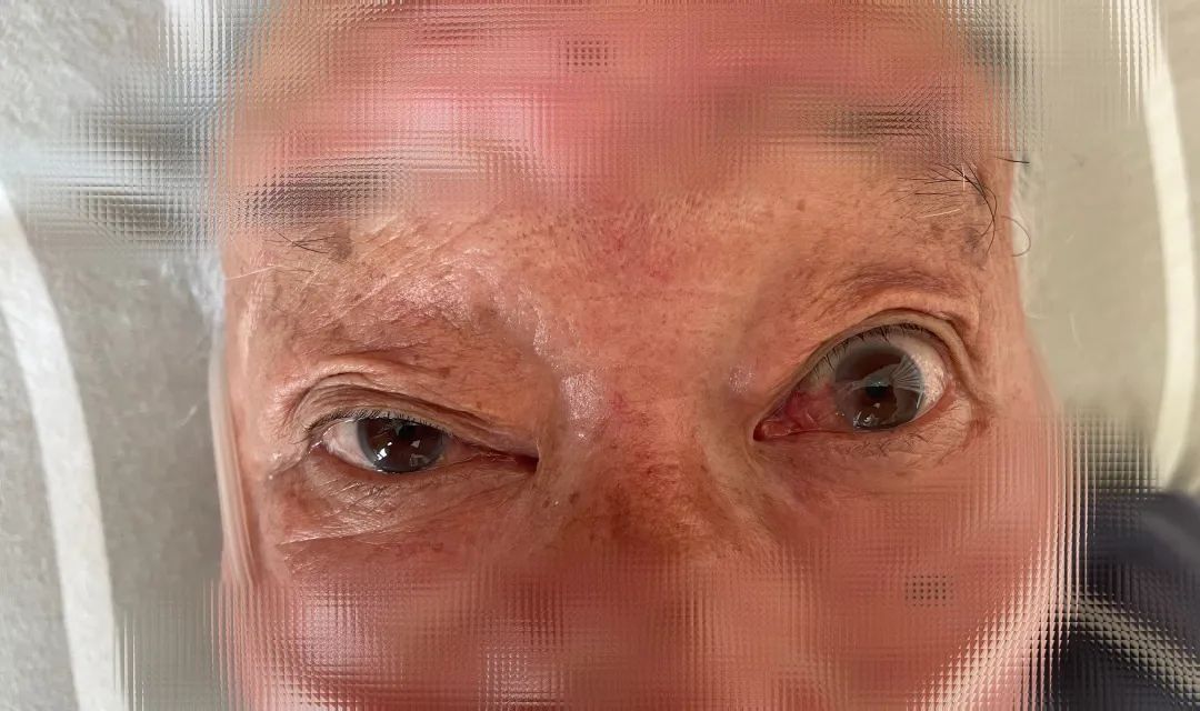 眼皮抬不起来了真困,眼皮抬不起来是阳吗