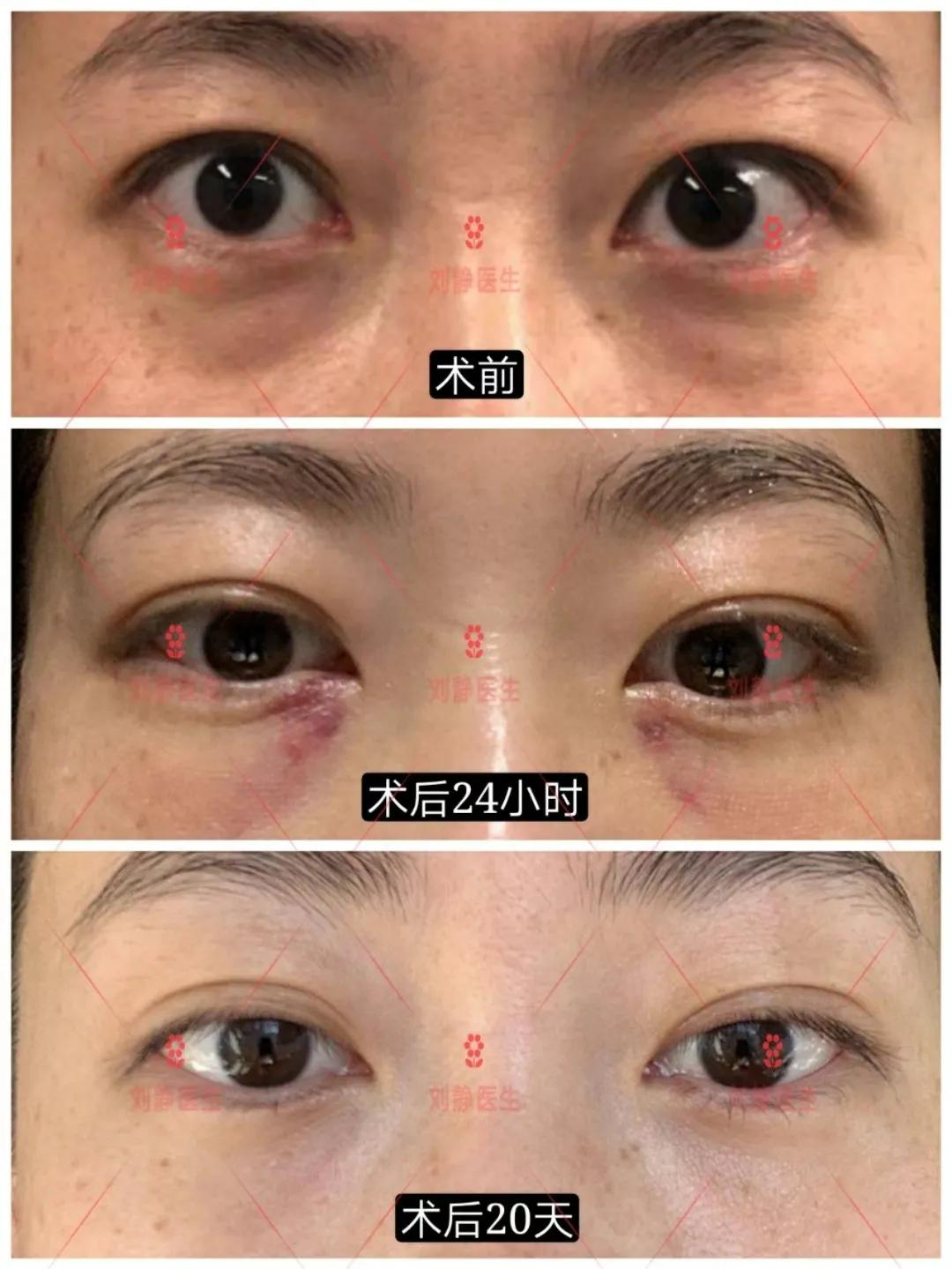 如何消除眼袋男生,如何消除眼袋黑眼圈的方法