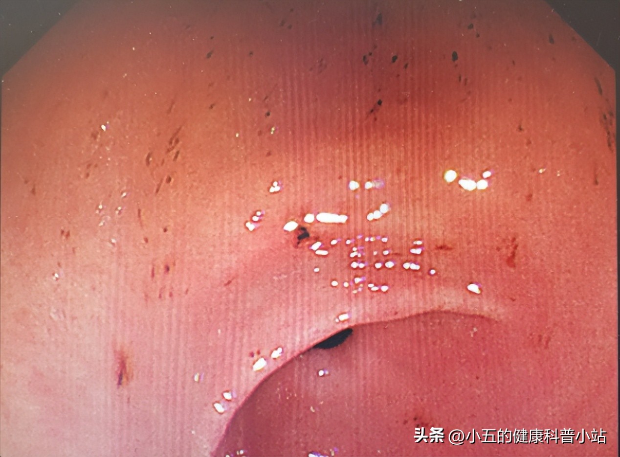 胃溃疡用药奥美拉唑效果好吗,奥美拉唑治胃溃疡最多连续吃几天