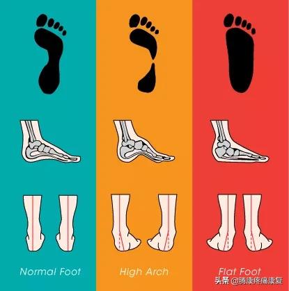 功能性高足弓的练习方式,足弓疼痛3个动作缓解