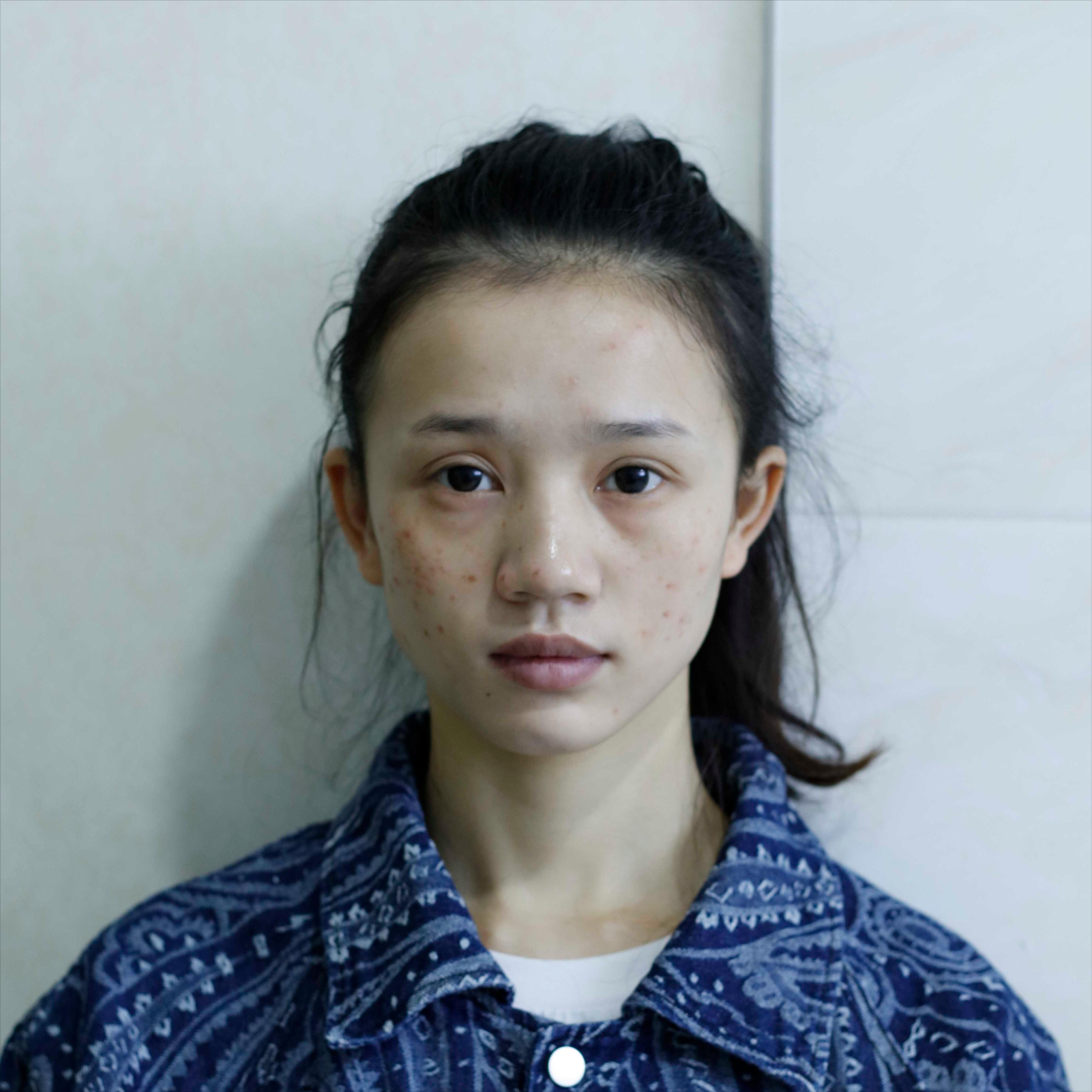 再漂亮的小姐姐也会被痘印困扰，治疗完后感叹激光治疗效果真不错