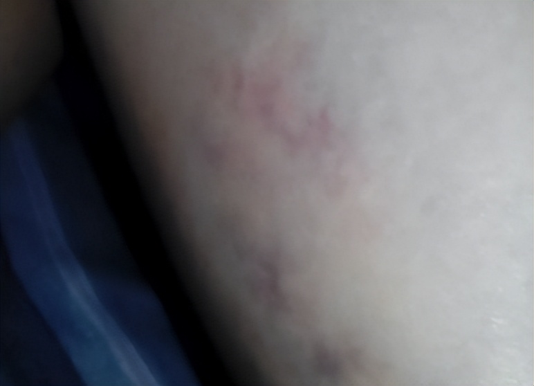 使用筋膜枪导致肌肉损伤怎么办,使用筋膜枪导致内脏受损