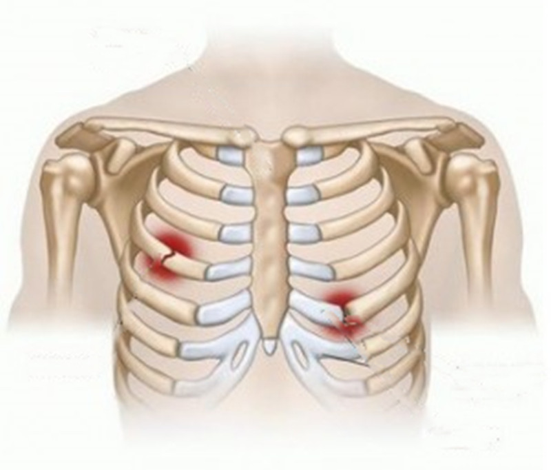 肋骨疼与肌肉疼的区别,肋骨疼是肌肉拉伤吗