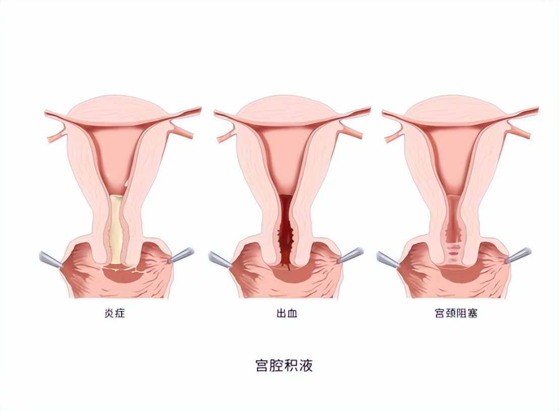 子宫性不孕症诊断与治疗,子宫发育不良性不孕确诊检查