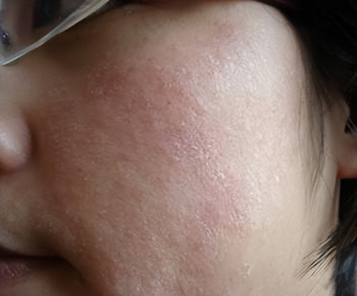 男生脸上很多处脱皮怎么办,男生脸上脱皮干燥