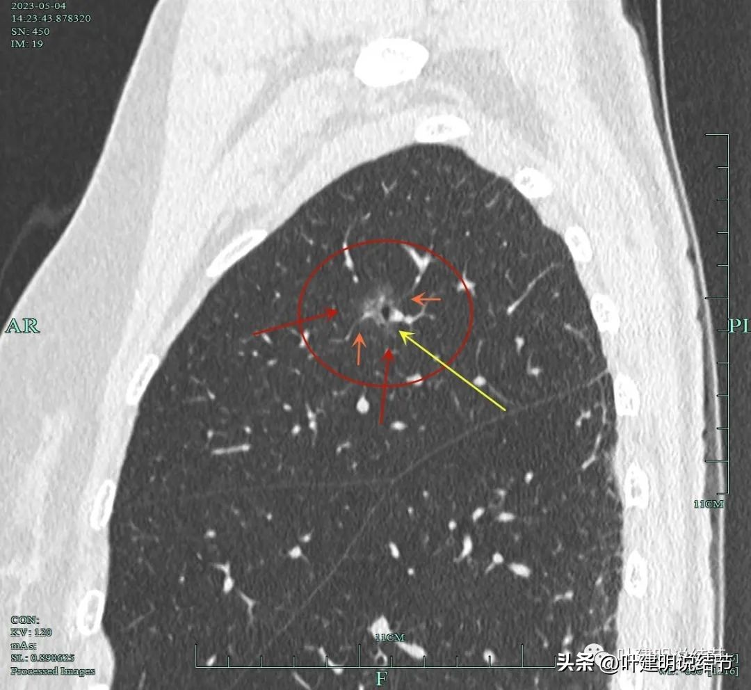 肺楔形切除肺功能降低,肺楔形切除需要缝合吗