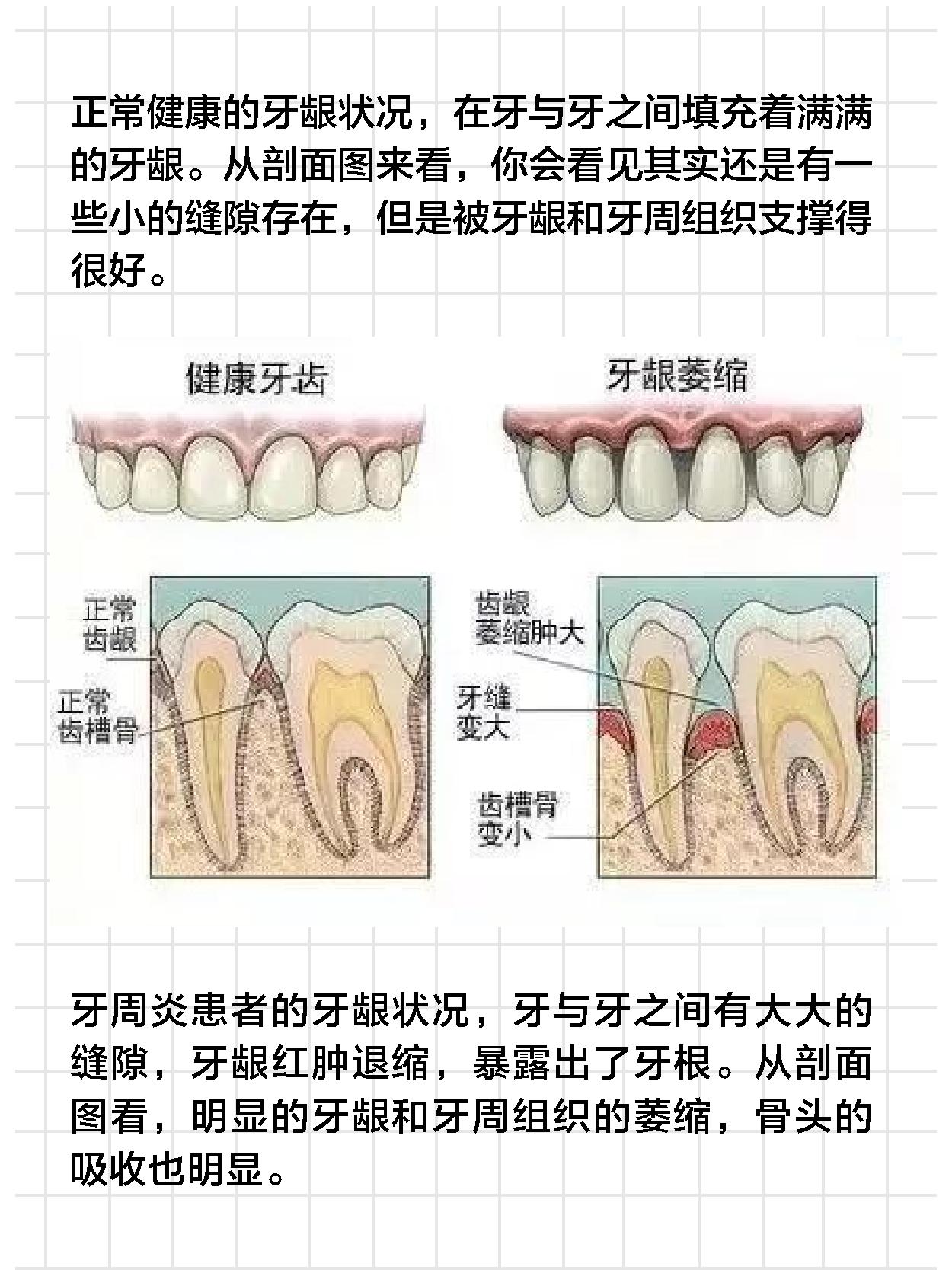 牙周炎导致牙肉萎缩牙缝增大,牙缝变大的原因及处理方法