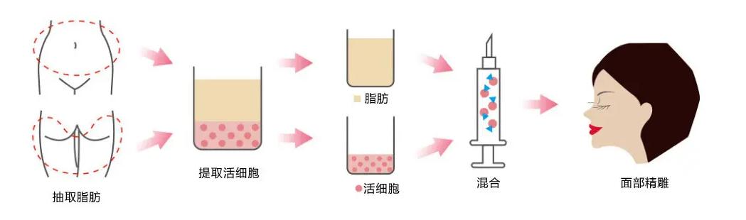 九院韦敏改脸型,九院填充太阳穴失败案例