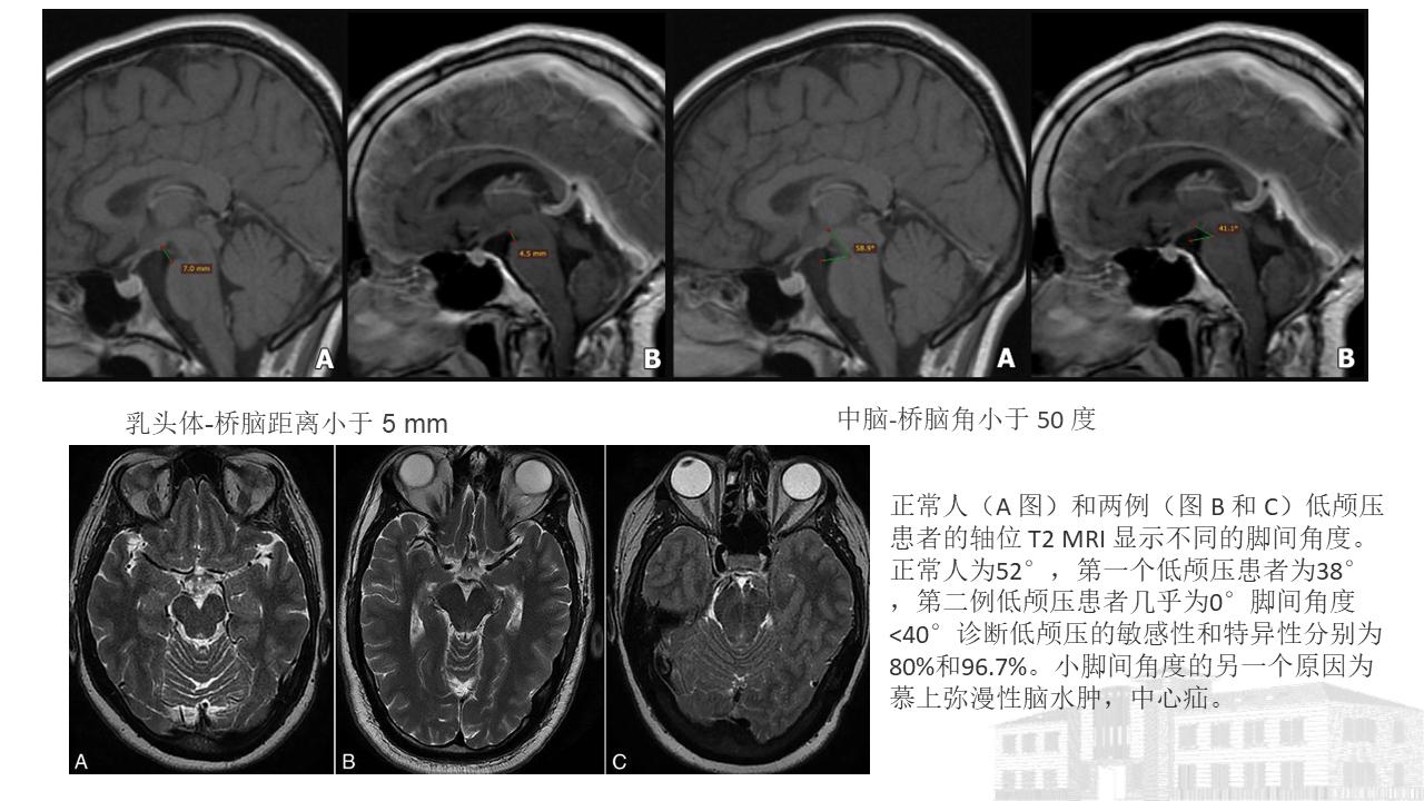 低颅压综合征耳闷,低颅压综合征吃什么药