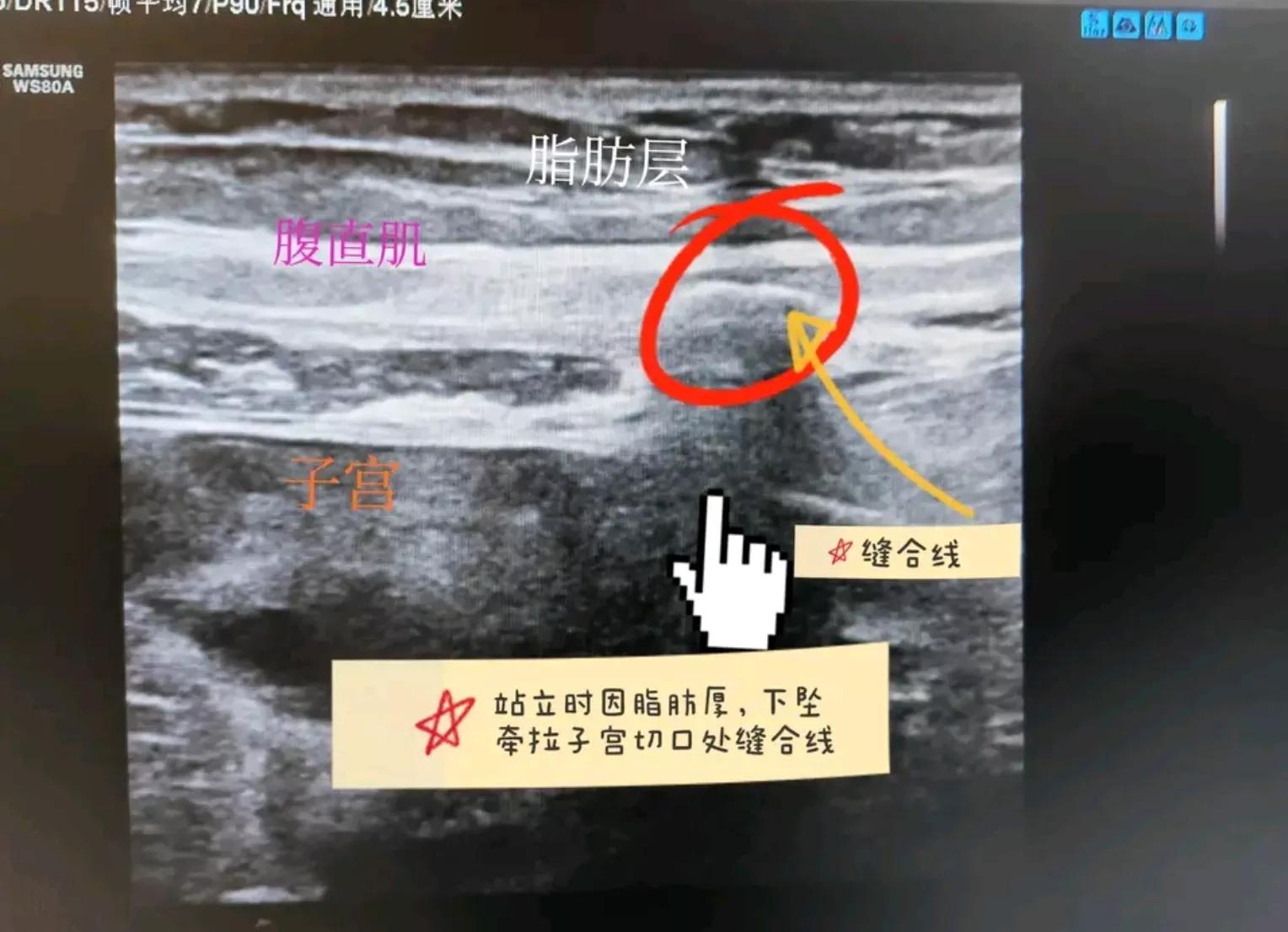 委屈肚子疼,剖宫产后肚子里不舒服