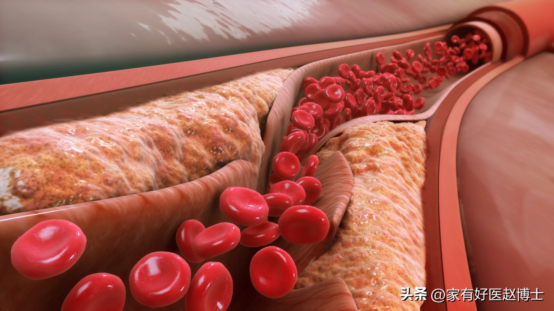 iwatch怎么预防心梗脑梗,张之瀛大夫如何预防心梗和脑梗