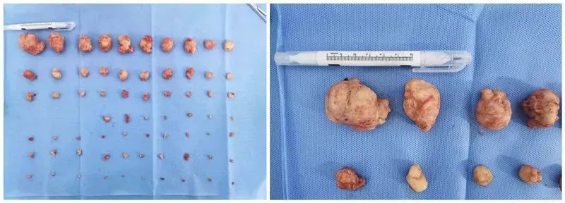 妇科肿瘤年轻化应该怎么预防,妇科恶性肿瘤有哪些早期信号