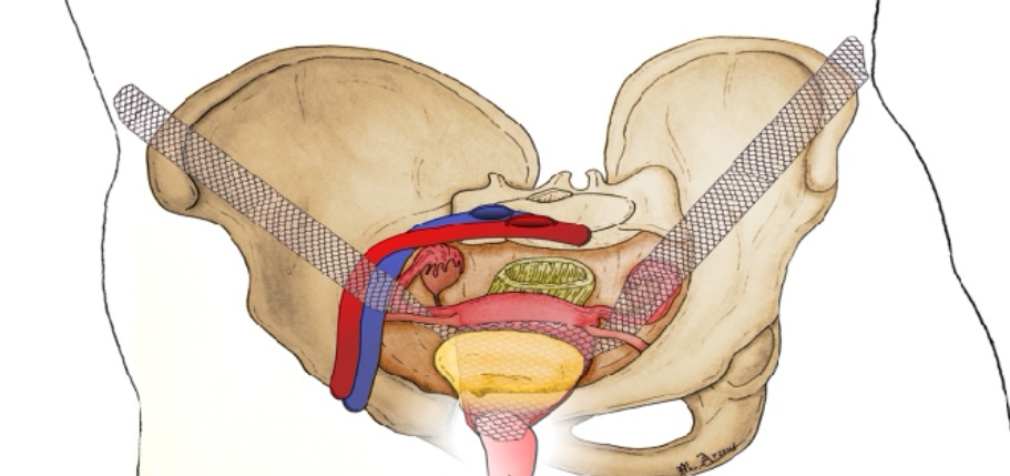 57岁阿姨子宫脱垂尿*禁失**腹腔镜手术一次解决2天出院