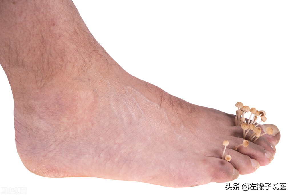 脚气反反复复如何治疗才能根除,脚气反反复复怎么根治