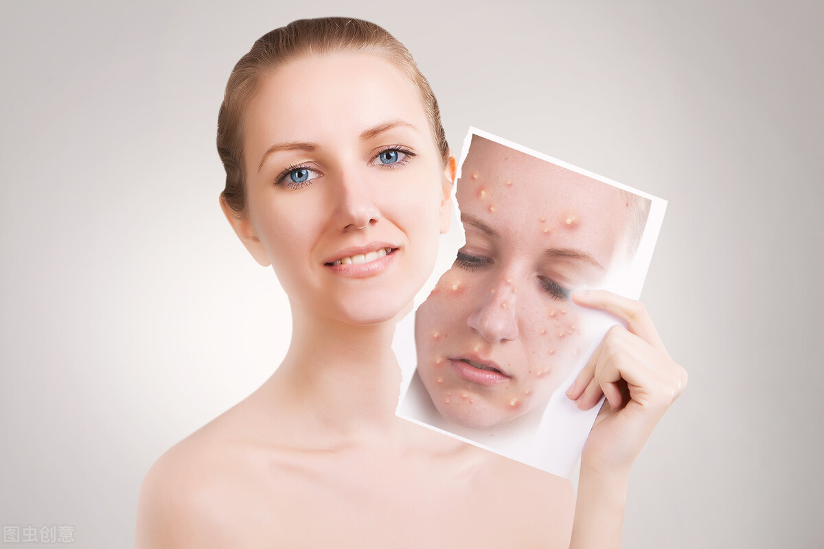 为什么我们脸上会长痘痘,少年脸上长了好多青春痘怎么办