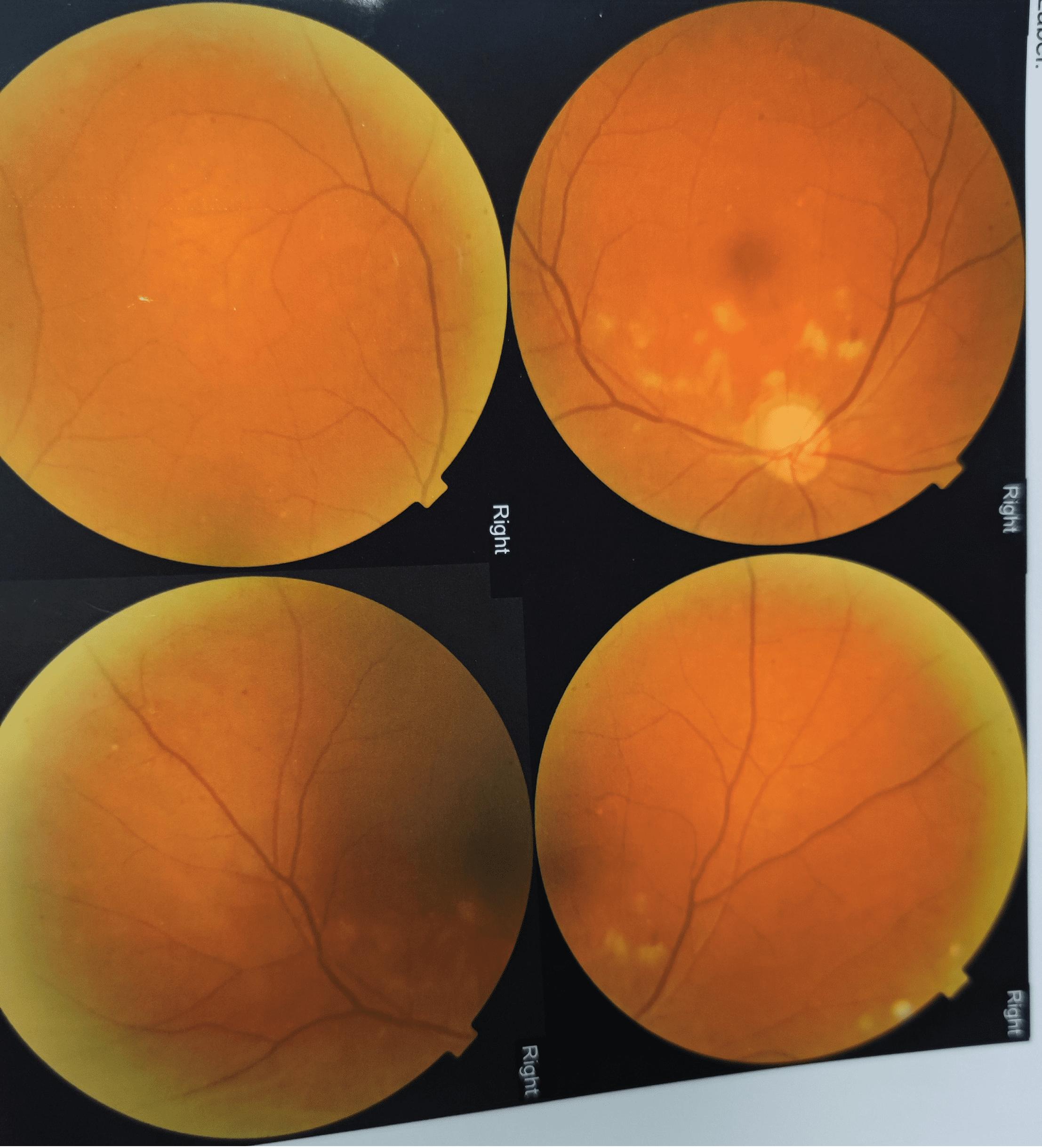 嘴巴摔伤会出脓吗,脸摔了一下眼睛失明了