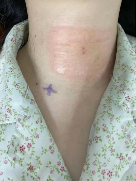 射频臭氧微创手术治疗颈椎病好吗,微创射频消融术治疗颈源性头痛