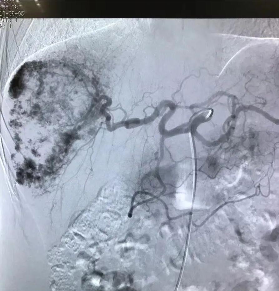 外周血管介入的适应症,介入治疗适用于所有疾病吗