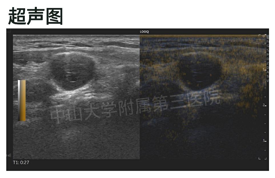 甲状腺癌切除后脖子上有小疙瘩,甲状腺癌切除后留有包膜会转移吗