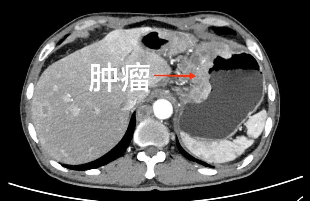 助力癌症康复,胃癌晚期转化治疗成功案例