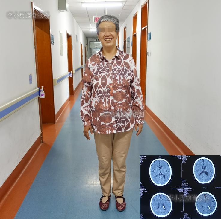 脑积水手术后4天还呕吐怎么回事,脑积水分流术后一直腹部疼痛