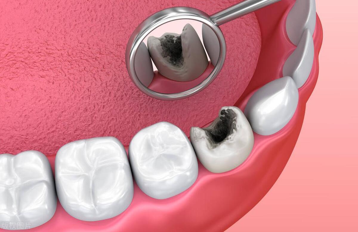 牙神经杀死后戴牙套几年后牙疼,杀死牙神经的过程是不是比较疼