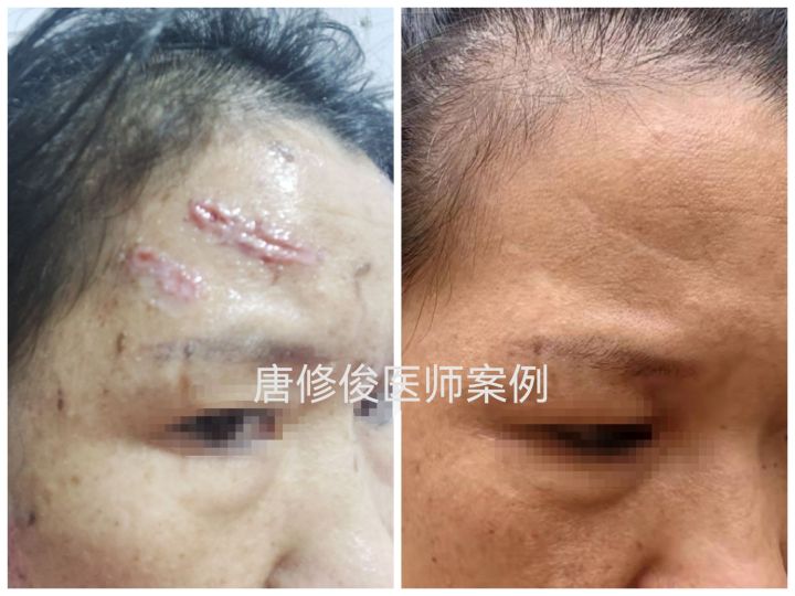 伤口做点阵激光治疗,点阵激光后怎么清理伤口