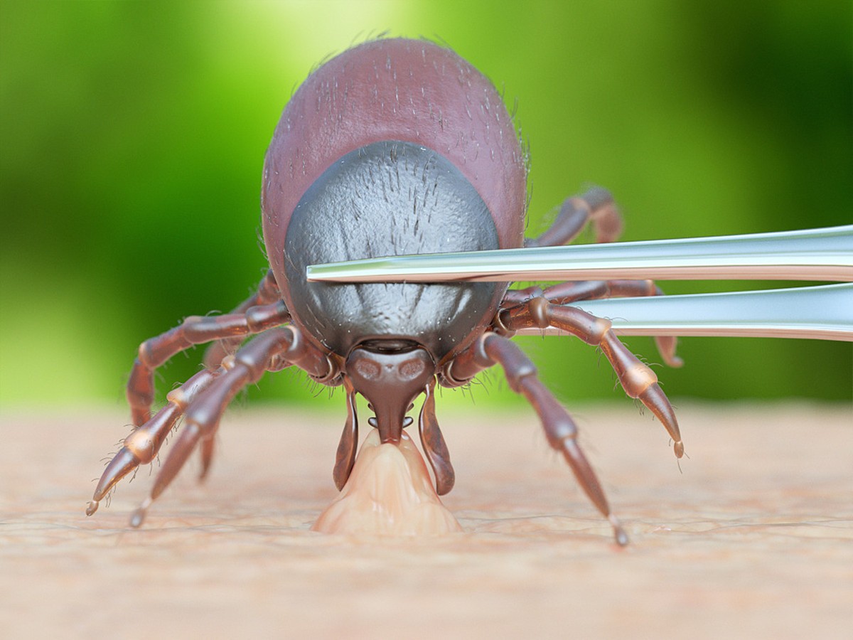 妈妈帮孩子理发发现蜱虫,小孩儿头上发现有蜱虫