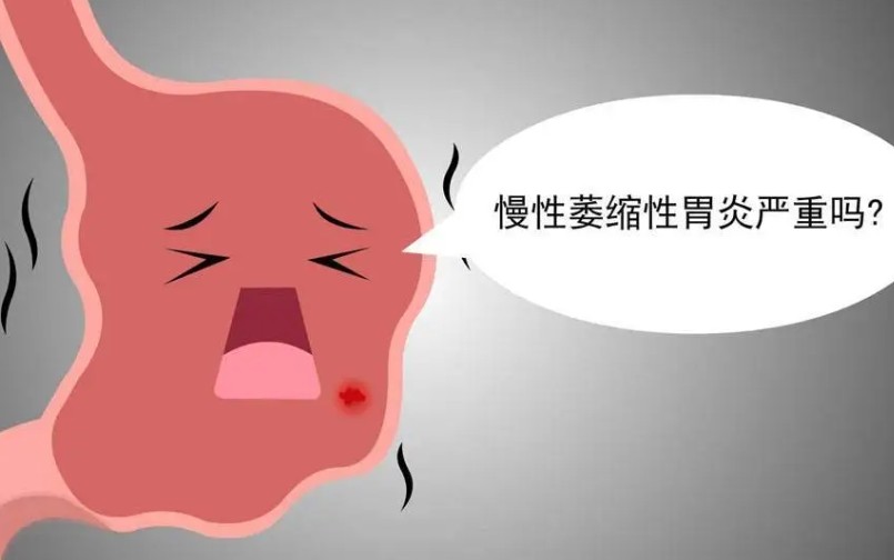 浅表性胃炎的中医治疗方法,浅表性胃炎食疗法