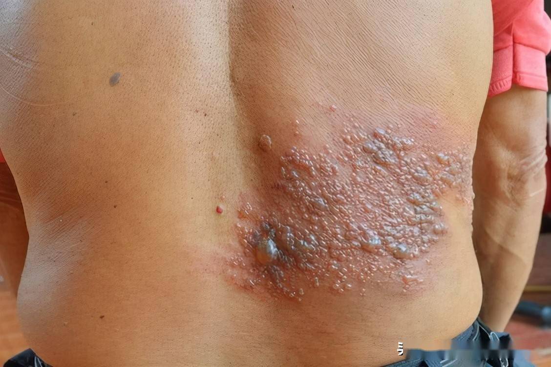 带状疱疹神经痛怎么止痛最有效,带状疱疹神经痛吃啥止痛效果好