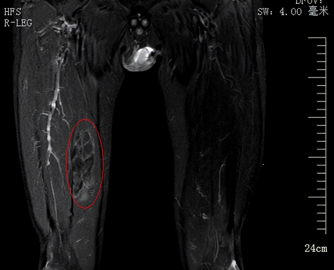 身体出现包块比较硬有疼痛感,身体上长了个包