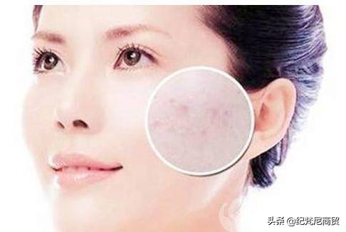 肌肤内干外油适合用什么护肤品,肌肤屏障受损外油内干怎样修复