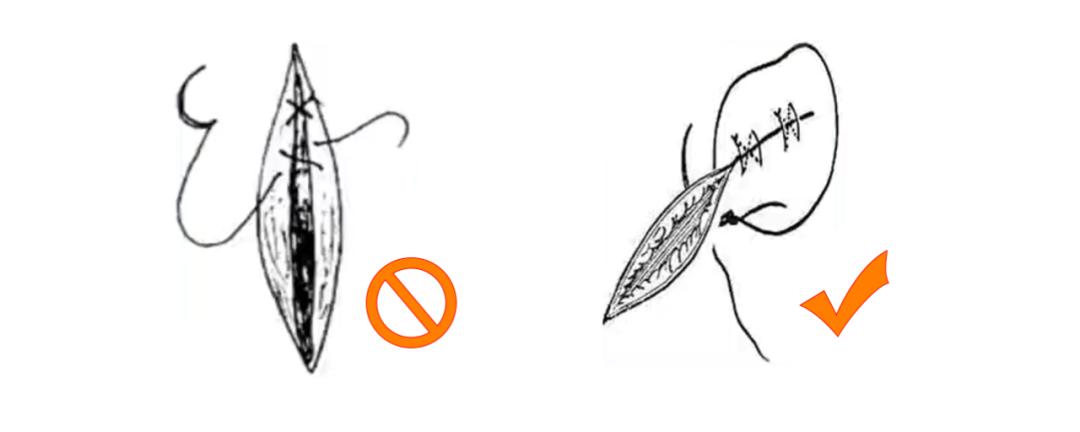 外科缝合技巧你熟练吗,外科缝合术的操作步骤