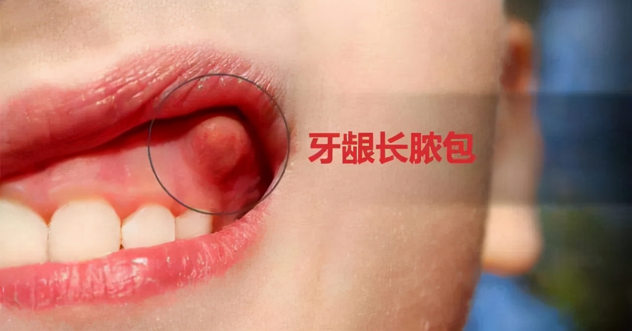 牙龈总是反复发炎肿痛是怎么回事,牙龈长时间出血会有什么并发症