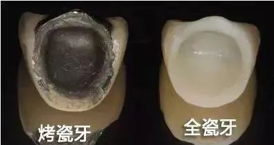 全瓷牙和烤瓷牙相比哪个更结实,全瓷牙和烤瓷牙哪个质量好一点