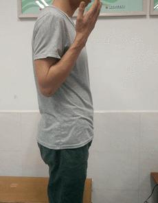 偏瘫手臂外旋受限怎样训练,偏瘫小臂和肘关节训练的正确方法