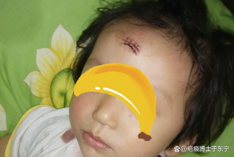 防止疤痕忌口食谱,防止疤痕体质的好方法