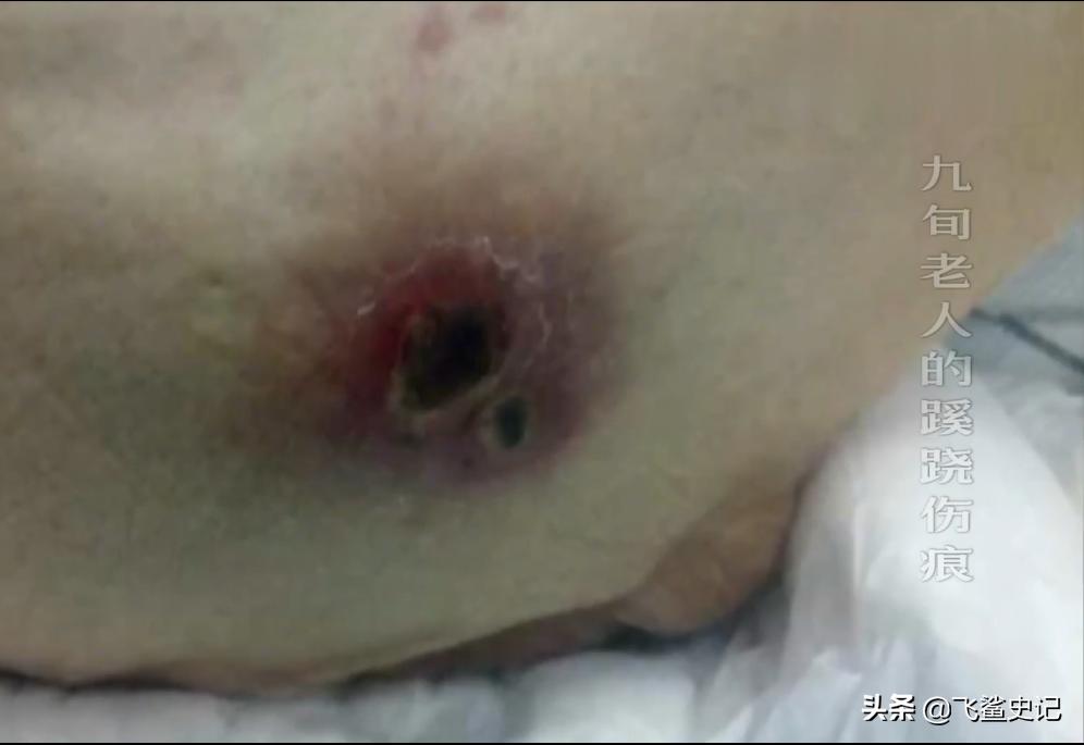 母亲被火灾烧伤,母亲被火烧死后续