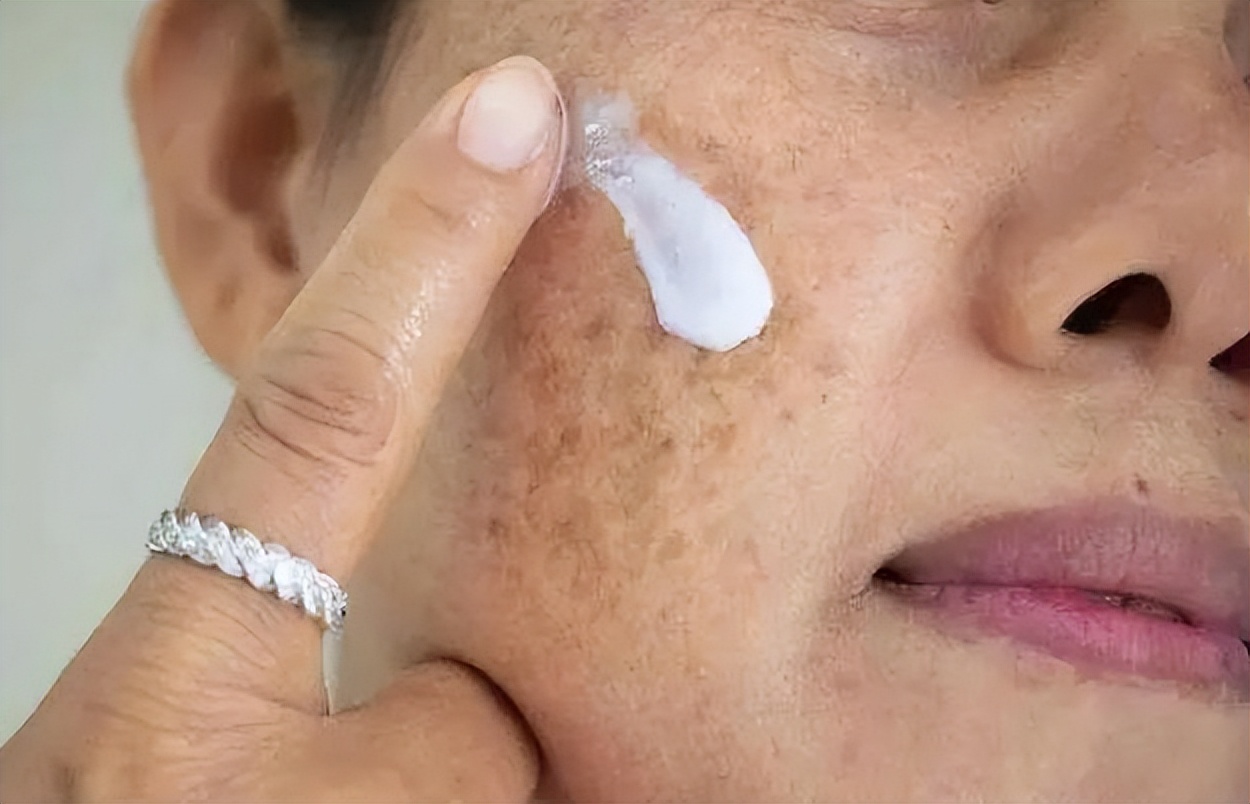 老人为什么长老年斑,红霉素软膏能祛老人斑吗