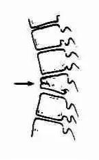 小朋友腰疼驼背怎么办,孩子弓腰驼背找哪科医生看