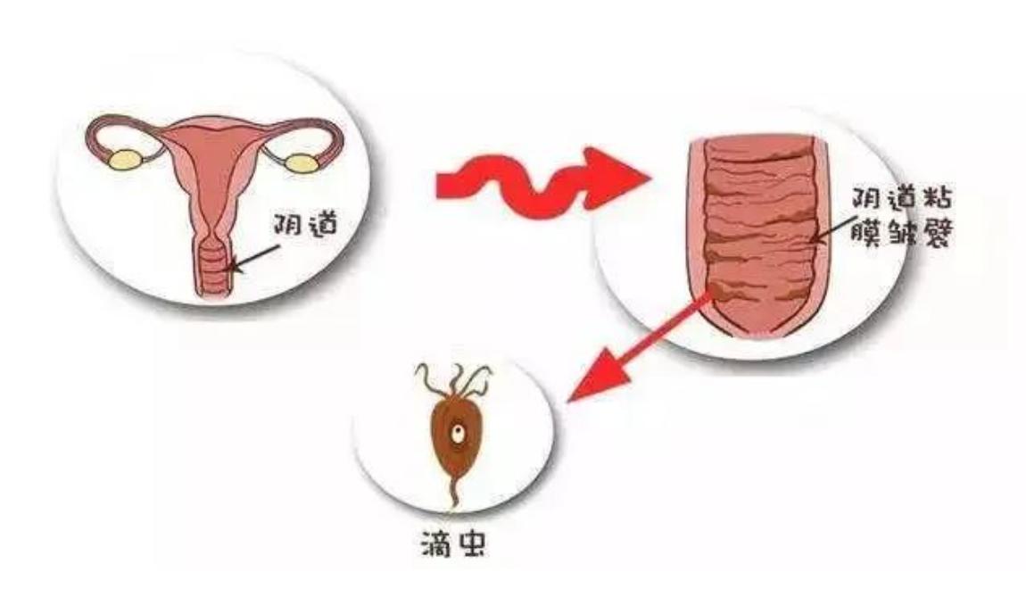 妊娠期患滴虫性阴道炎该如何治疗？点进来看看就知道了